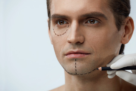 Portrait Of Handsome Young Man With Lines On Face Before Plastic Surgery Operation. Closeup Surgeon Hand Applying Black Line With Pencil On Male Patient Skin. Facial Beauty Procedure. High Resolutionの写真素材