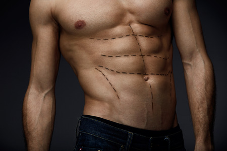 Man Sexy Body With Black Lines On Skin. Closeup Of Beautiful Fit Muscular Male Torso With Pencil Surgical Marks On Abs Before Plastic Surgery, Beauty Operation On Black Background. High Resolutionの写真素材