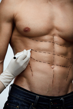 Plastic Surgery. Closeup Of Young Man's Fit Torso With Surgical Lines On His Body Before Beauty Operation. Doctor's Hand In Sterile Glove Drawing Black Marks On Male Patient Body. High Resolutionの写真素材