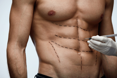 Male Body Surgery. Closeup Of Young Man's Fit Torso With Surgical Lines On Abs Before Plastic Surgery Operation. Close-up of Doctor's Hand Holding Scalpel Near Man's Body Skin. High Resolutionの写真素材
