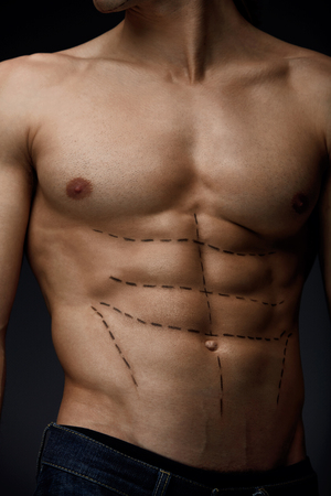 Man Sexy Body With Black Lines On Skin. Closeup Of Beautiful Fit Muscular Male Torso With Pencil Surgical Marks On Abs Before Plastic Surgery, Beauty Operation On Black Background. High Resolutionの写真素材