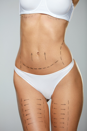 Surgical Lines On Beautiful Woman's Body. Closeup Of Female Slim Fit Body With Black Marks On Skin Before Plastic Surgery Operation. Girl In Perfect Sexy Body Shape In White Underwear. High Resolutionの写真素材