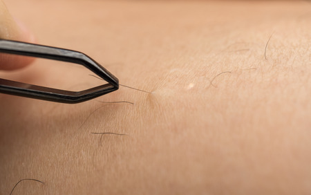 close-up detail of woman using pair of tweezers, removing hair from hairy leg. With dry skin problemの写真素材