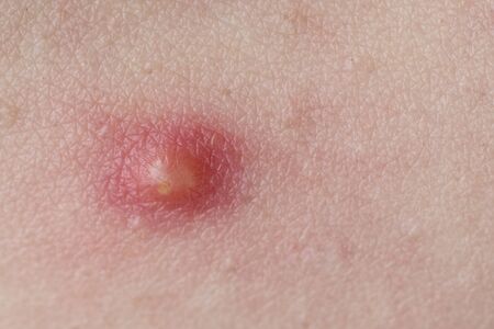 pimple on skin infection Pimple to Poppingの写真素材