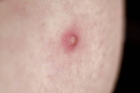 pimple on skin infection Pimple to Poppingの写真素材