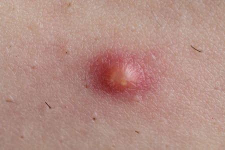 pimple on skin infection Pimple to Poppingの写真素材