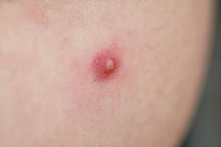 pimple on skin infection Pimple to Poppingの写真素材