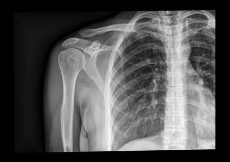 x-ray shoulder radiograph displaying Acromioclavicular sprain disruption, sports injuryの写真素材