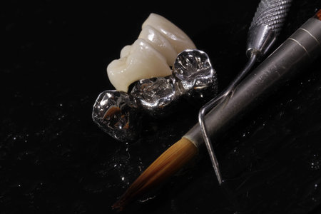 E-max pressed ceramic bridge and metal crown, dentistry utensils and mock-up