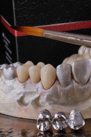 E-max pressed ceramic bridge and metal dental crown with dentistry utensils and mockup