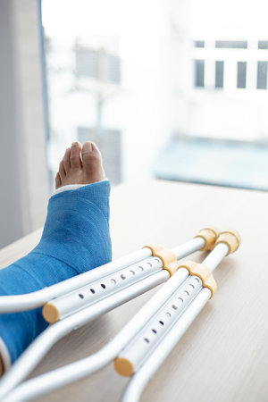 Blue ankle and foot splint Bandages on the legs from a young man's fall accident, Blue plaster on the ankle, Crutches assist in the walking of the patient.の写真素材