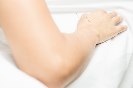 Acupuncture patient with needles along armの写真素材