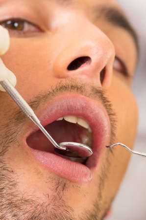 closeup portrait of young handsome man at the dentist with mouth openの写真素材