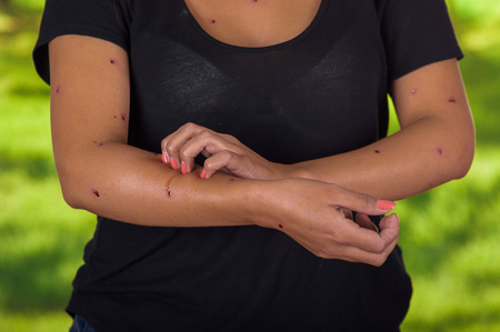 Young woman wearing a black blouse and suffering from itch after mosquito bites, in a blurred green backgroundの写真素材