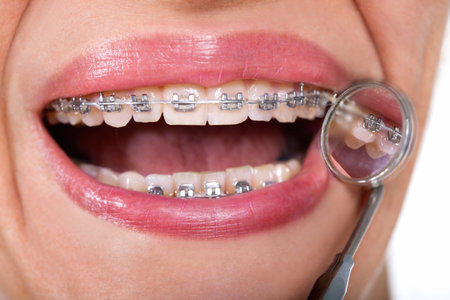 lingual braces on dental mirror, close up