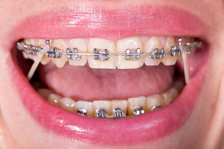 Open Female Mouth with Self-ligating Braces. Orthodontic Treatmentの写真素材
