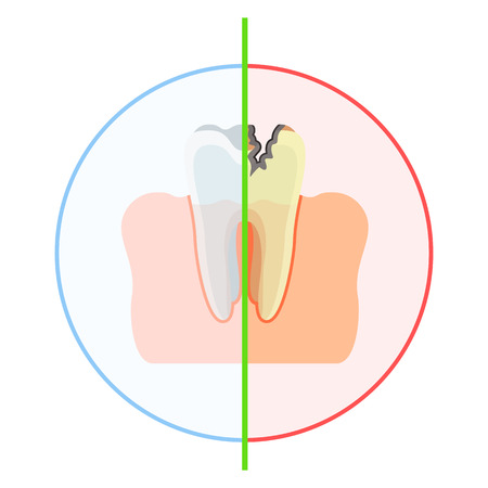 Healthy vs damaged tooth.のイラスト素材