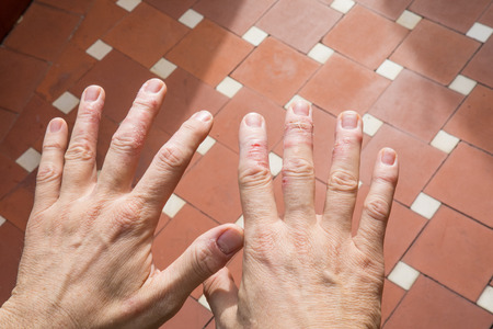 man showing his hands with eczema in skin fingersの写真素材