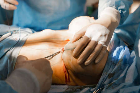 Surgeon with headlamp and scissors do plastic operation in medical clinic. Chest augmentation plastic operation and correction in medical clinicの写真素材