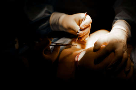 Surgeon with headlamp and scissors do plastic operation in medical clinic. Chest augmentation plastic operation and correction in medical clinicの写真素材