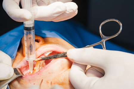 Close-up Buccal fat removal. Bisha lumps removal. Plastic surgery in clinic. Plastic surgery...