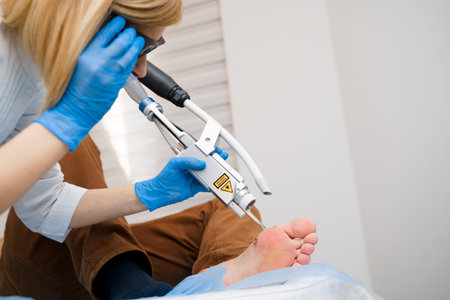 Laser removal of warts on the foot. Medical dermatological surgery in the clinic.の写真素材