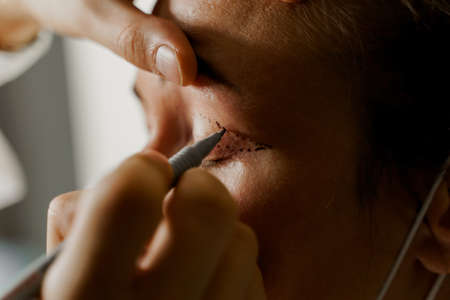 Blepharoplasty markup on the face of a beautiful female before the plastic surgery operation for modifying the eye region of the face in medical clinic. 2 doctors do plastic cosmetic operationの写真素材