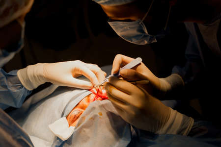 Blepharoplasty plastic surgery operation for modifying the eye region of the face in medical clinic. 2 doctors do plastic cosmetic operation for woman. Surgeon makes an incision with a surgical knifeの写真素材