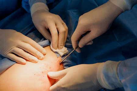 Liposuction for lipofilling surgery operation. close-up photo of 2 surgeon do plastic surgery named...