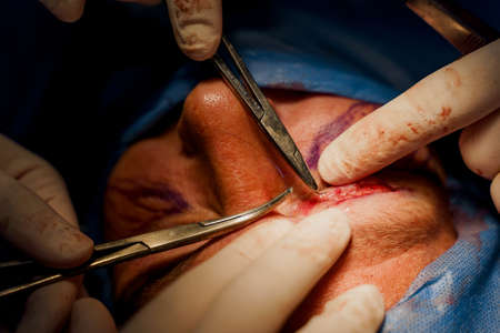 Close-up blepharoplasty lipofilling plastic surgery operation for modifying the eye region of the...
