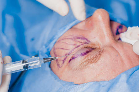 Close-up anesthesia before blepharoplasty and lipofilling plastic surgery operation for modifying...