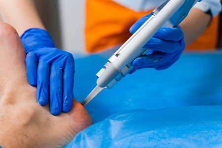 Laser removal of warts on the foot. Medical dermatological surgery in the clinic.の写真素材