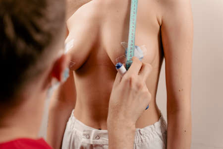 Breast augmentation surgery markup. Preparation for plastic surgery for introduction of silicone implantの写真素材