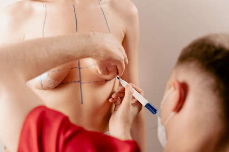 Breast augmentation surgery markup. Preparation for plastic surgery for introduction of silicone implantの写真素材