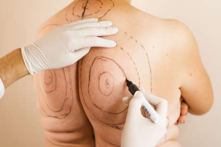 Markup fat woman before kyphosis surgery. Dowager hump. Surgeon is marking back of woman for...