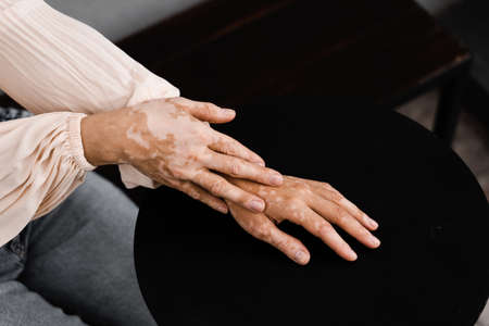 Hands with vitiligo skin pigmentation on black background close-up. Lifestyle with Seasonal skin diseasesの写真素材