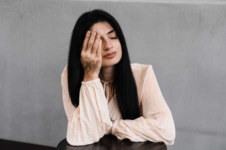 Tender woman with vitiligo pigmentation patches on hands closes her eyes and relaxes. Lifestyle with skin seasonal diseasesの写真素材