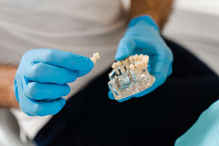 Artificial plastic jaw with dental implants close-up. Dental prosthetics and implants. Dental prosthetics consultation with dentist for patient woman in dentistryの写真素材