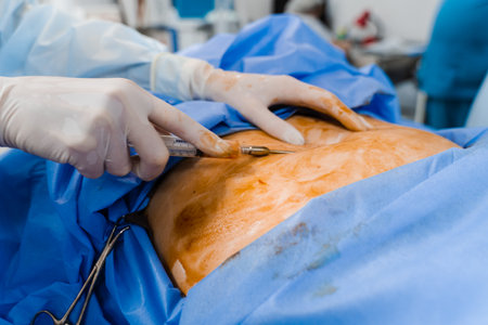 Liposuction close-up. Surgeon does abdominoplasty plastic operation to reduce the abdomen and remove cellulite. Correcting body shapeの写真素材