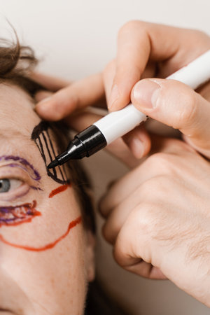 Brow lifting browpexy is a suture suspension of the brow to the underlying bone. Browpexy markup close-up on the face for brow lift before the plastic surgery operationの写真素材