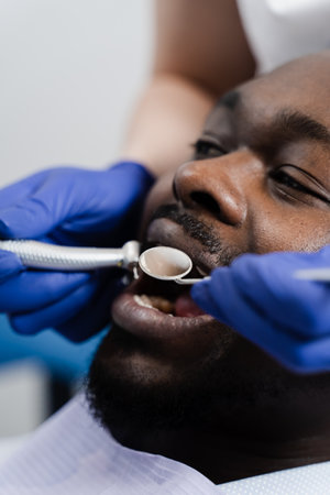 Dental drill close-up. Dentist drilling teeth of african man in dentistry clinic. Teeth treatment. Dental filling for african american man patientの写真素材