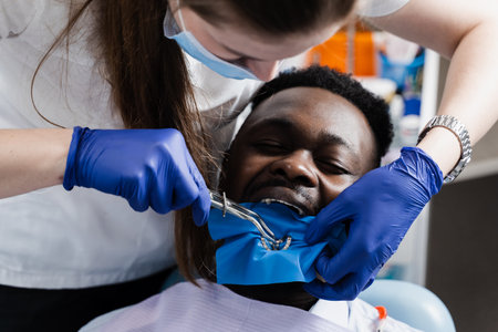 Process of installing dental cofferdam in jaw of african man for treatment teeth in stomatology. Dentist using dental dam for tooth isolationの写真素材
