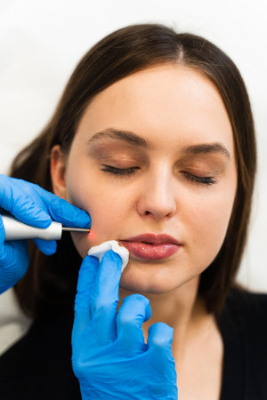 Beautician with laser cleans skin off birthmarks. Laser removing mole from face of patient