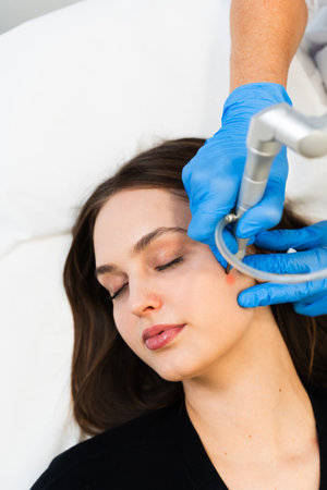 Laser removing moles and birthmarks from face of attractive girl. Cosmetologist applies laser device...