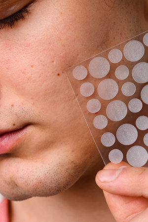 Healing acne on sensitive skin without scars and infection with transparent pimple patch. Invisible...