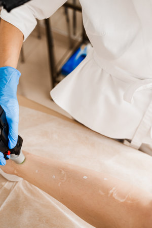 Laser epilation targeting the hair follicles at their roots. Getting smooth skin on legs with a...