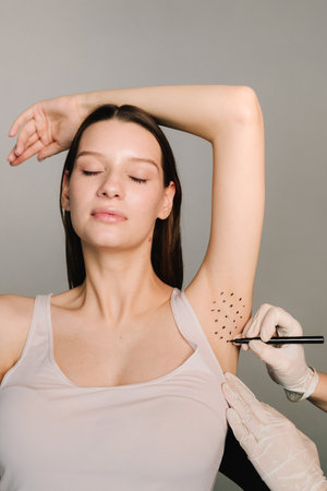 Markup skin for hyperhidrosis treatment in the clinic. Treatment of hyperhidrosis. Cosmetologist is marking dotes before injecting woman's armpit, closeupの写真素材