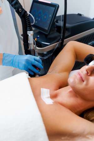 Man getting laser epilation on armpits by epilation master. Laser for removal unwanted hair on male's armpits. Cosmetic male laser epilationの写真素材
