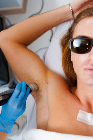 Cosmetic male laser epilation. Man getting laser epilation on armpits by epilation master. Laser for removal unwanted hair on male's armpitsの写真素材
