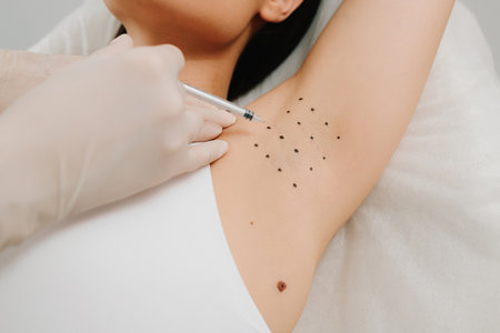 Hyperhidrosis injection for underarm. Intradermal injection procedure for underarm hyperhidrosis. Cosmetologist performing botulinum toxin injections in a woman underarm to manage excessive sweatingの写真素材
